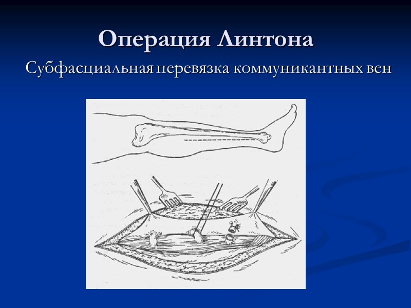 Операция Линтона Субфасциальная перевязка коммуникантных вен